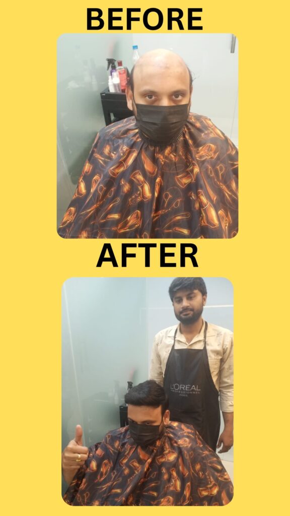 Non surgical Hair Replacement