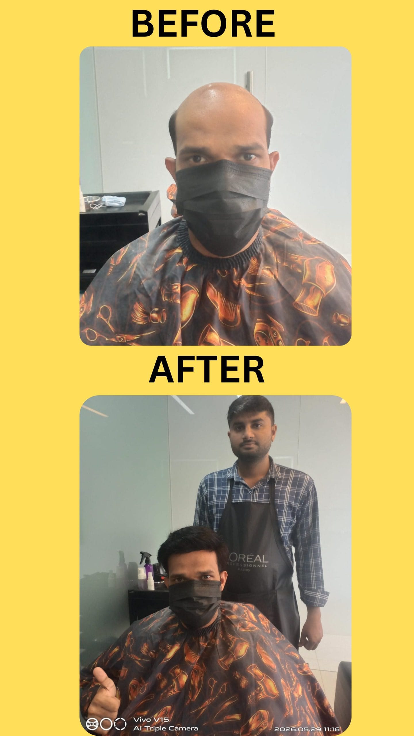 Hair Replacement Without Surgery in Hyderabad